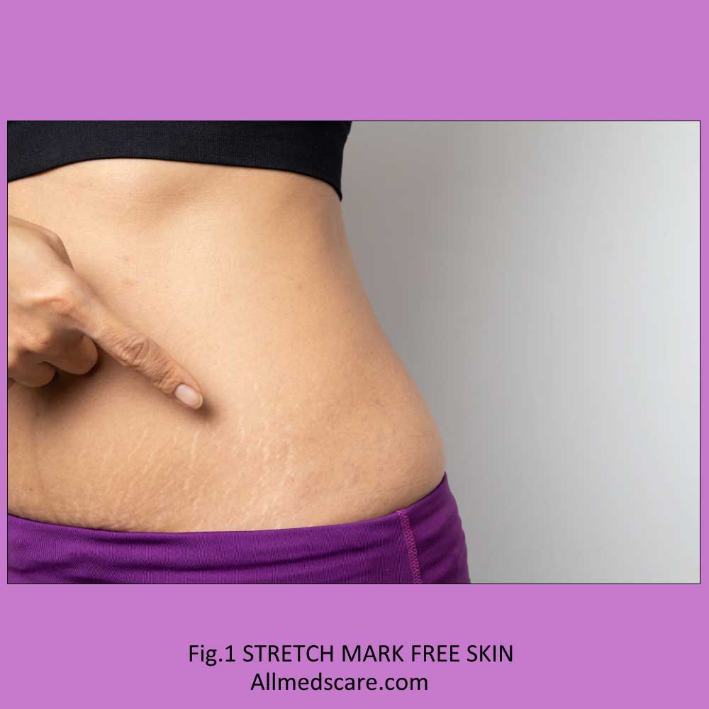 Stretch Marks - Meaning & Prevention, Treatment Remedies