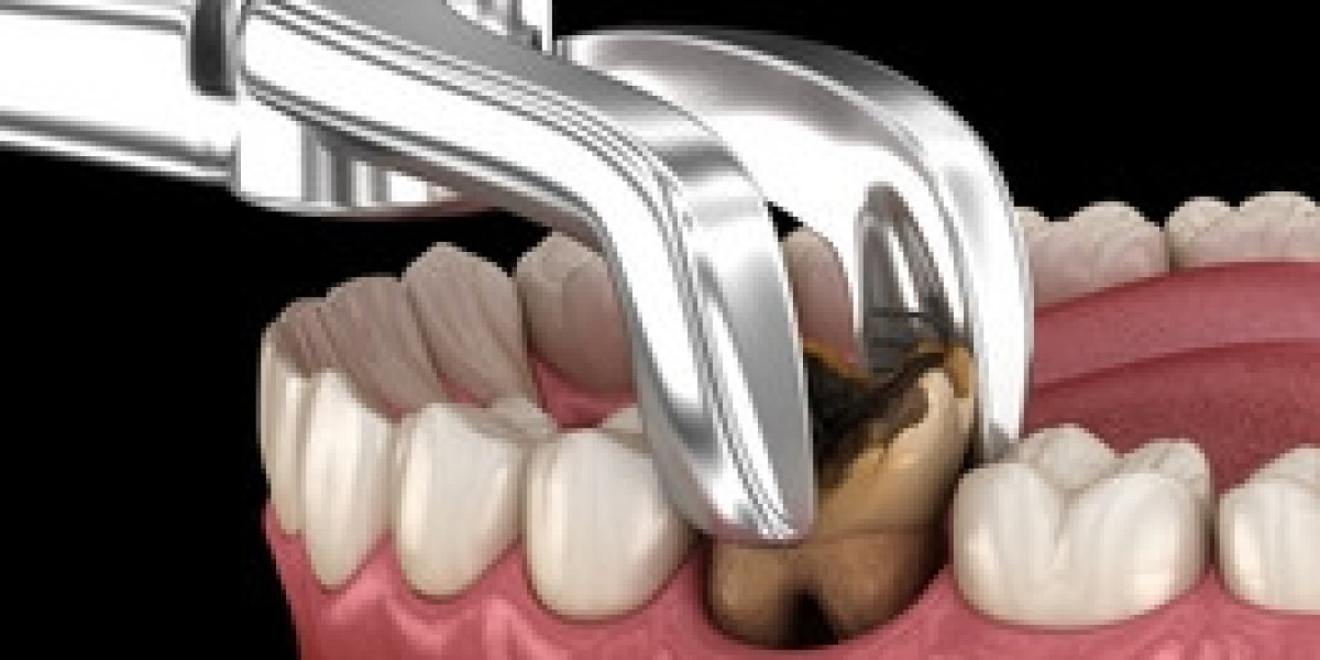 Painless Tooth Extraction in Hoodi: A Guide to Comfortable Dental Care