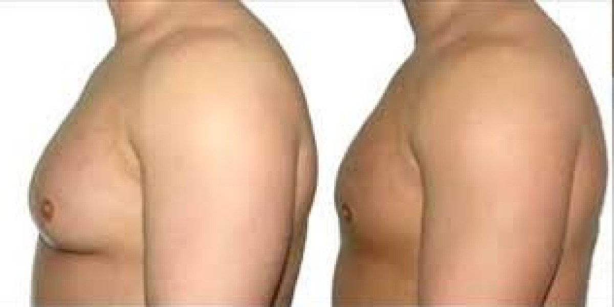 Top Clinics for Gynaecomastia Surgery in Dubai: What Patients Should Look For