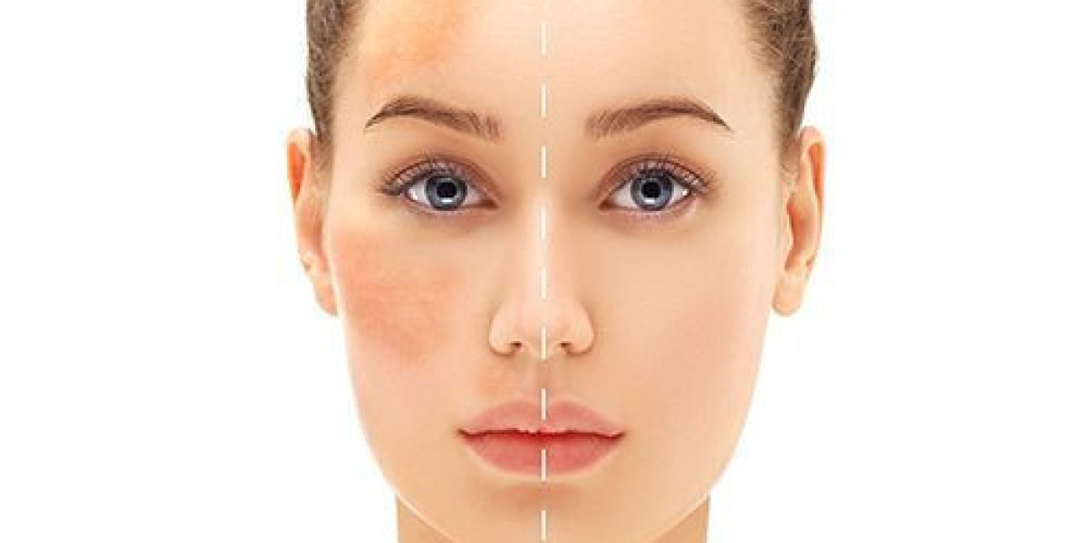 Birthmark Removal in Dubai: Restore Your Natural Beauty