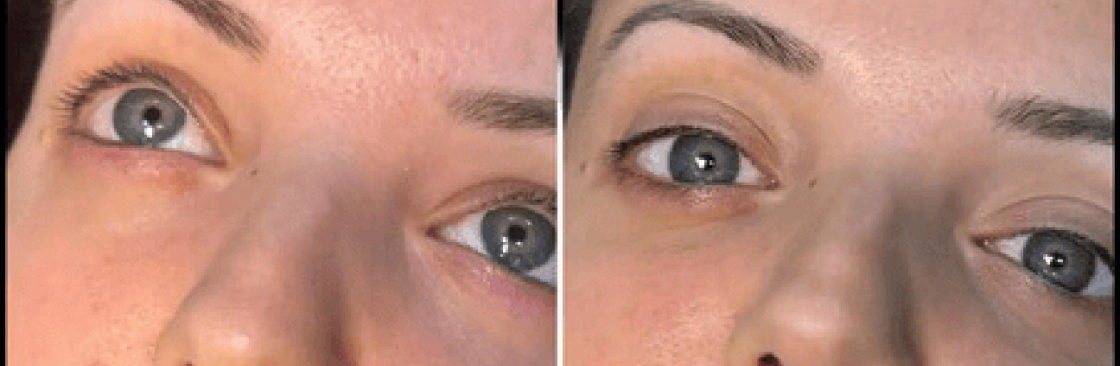 dermal fillers Cover Image