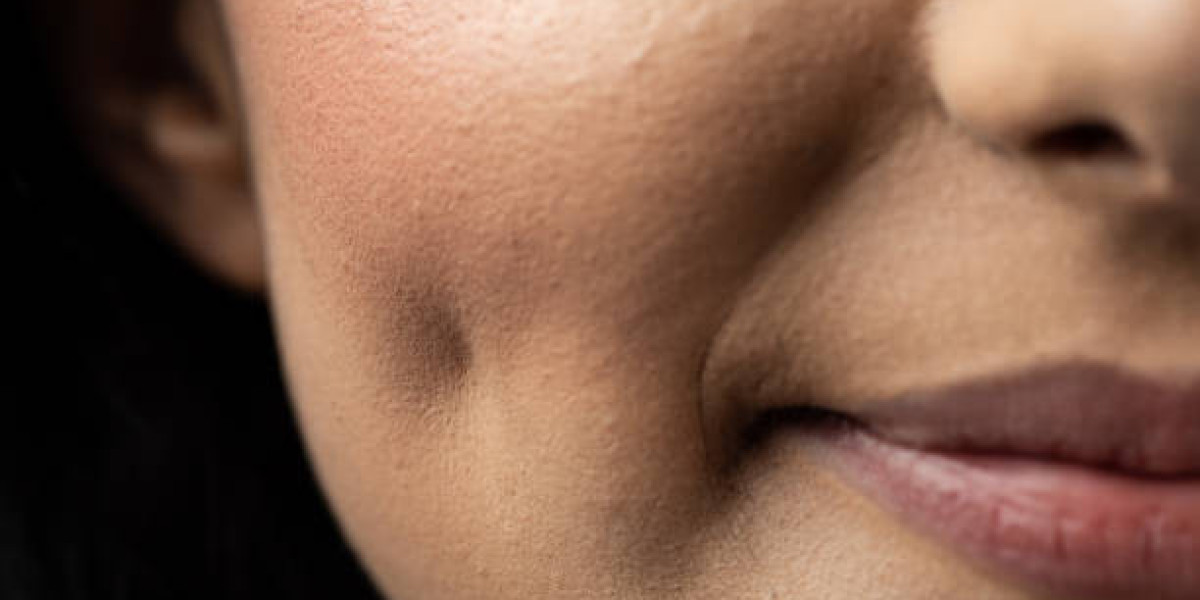 Vampire Facelift in Dubai: Natural Anti-Aging Solution