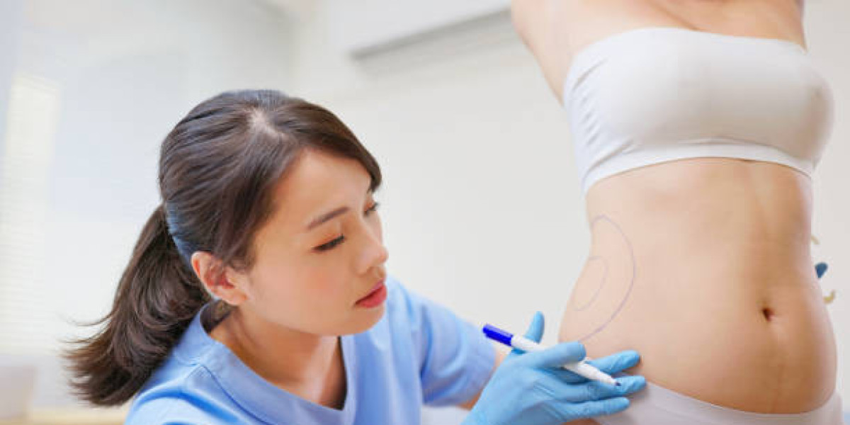 Liposuction Surgery in Dubai for Stubborn Fat