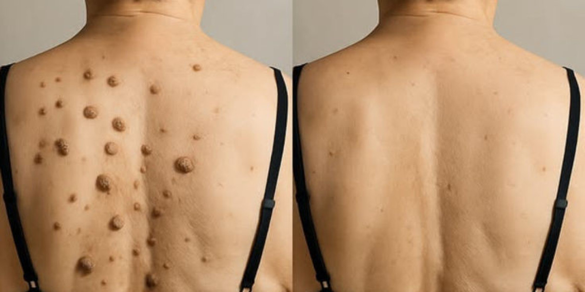 Birthmark Removal in Dubai: Understanding Different Laser Technologies