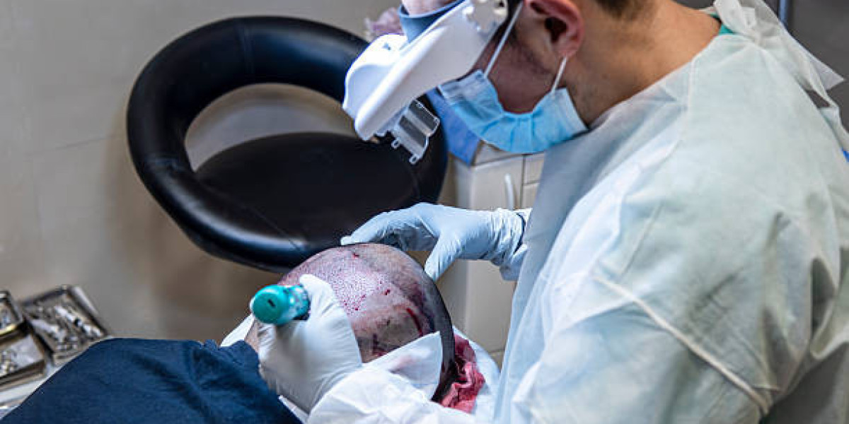 Hair Transplant Cost: What You Need to Know Before Treatment