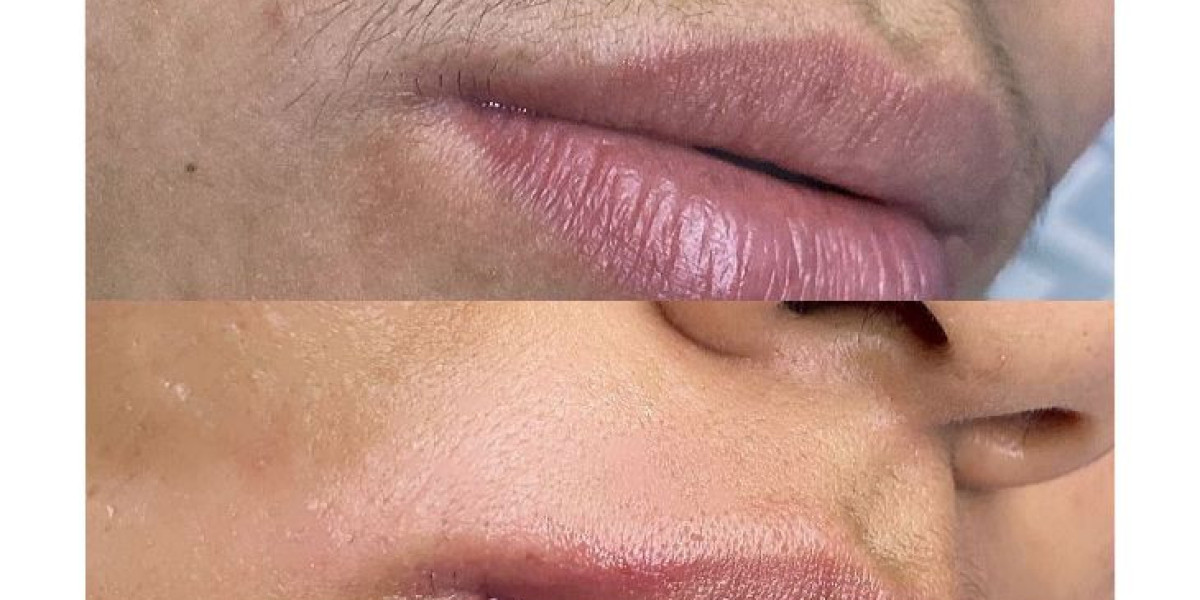 Laser Hair Removal – Smooth Skin with Long-Lasting Results