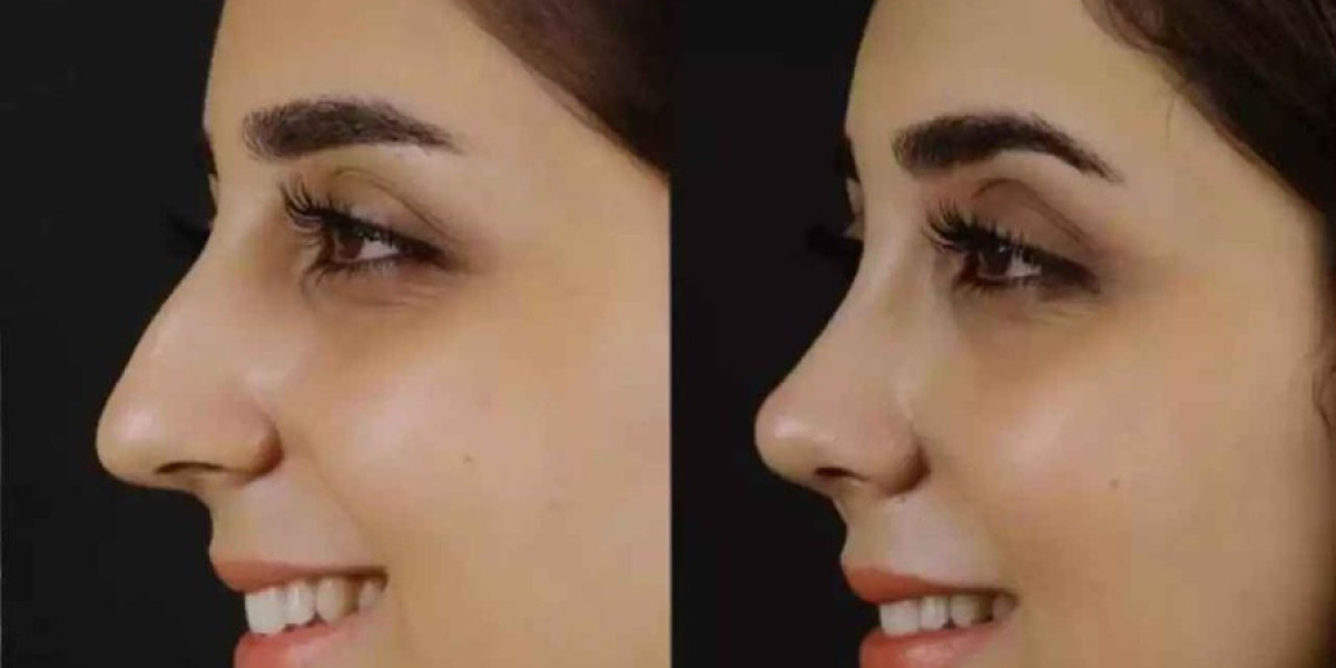 Best Septoplasty Surgeon in Dubai: Experience, Skill, and Accuracy