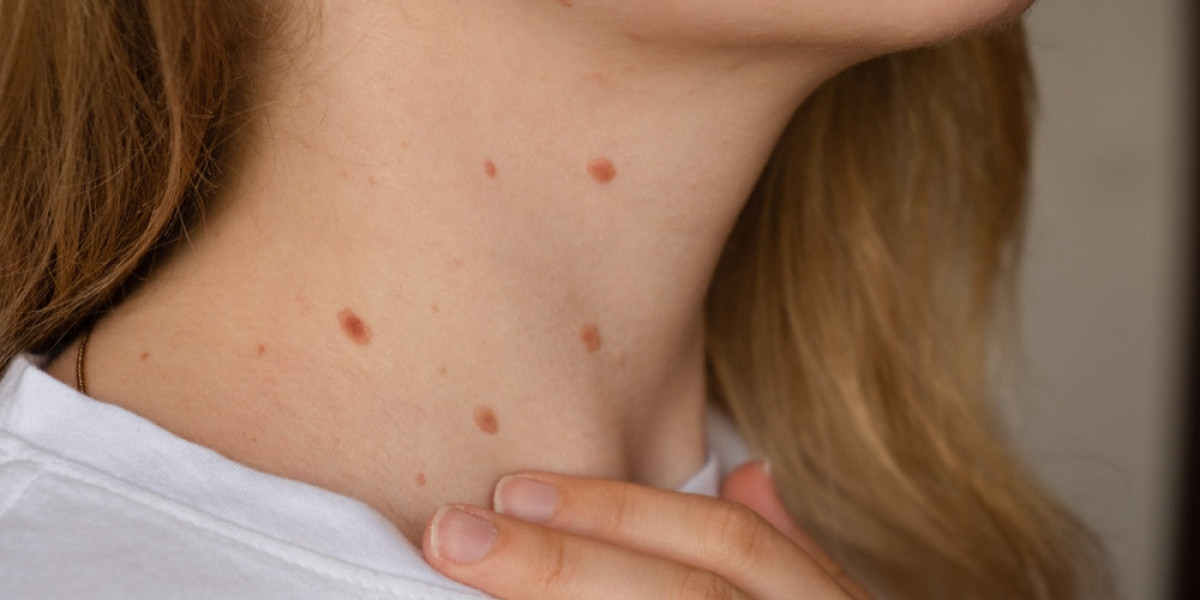 Dermatologist Insights: Are Skin Tags Contagious