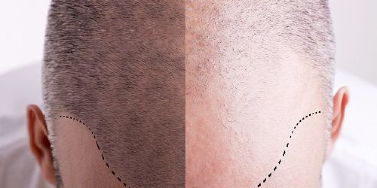Does FUE Hair Transplant Treatment Require Downtime?