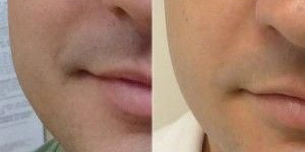 Mole Removal in Dubai: Safe and Effective Solutions
