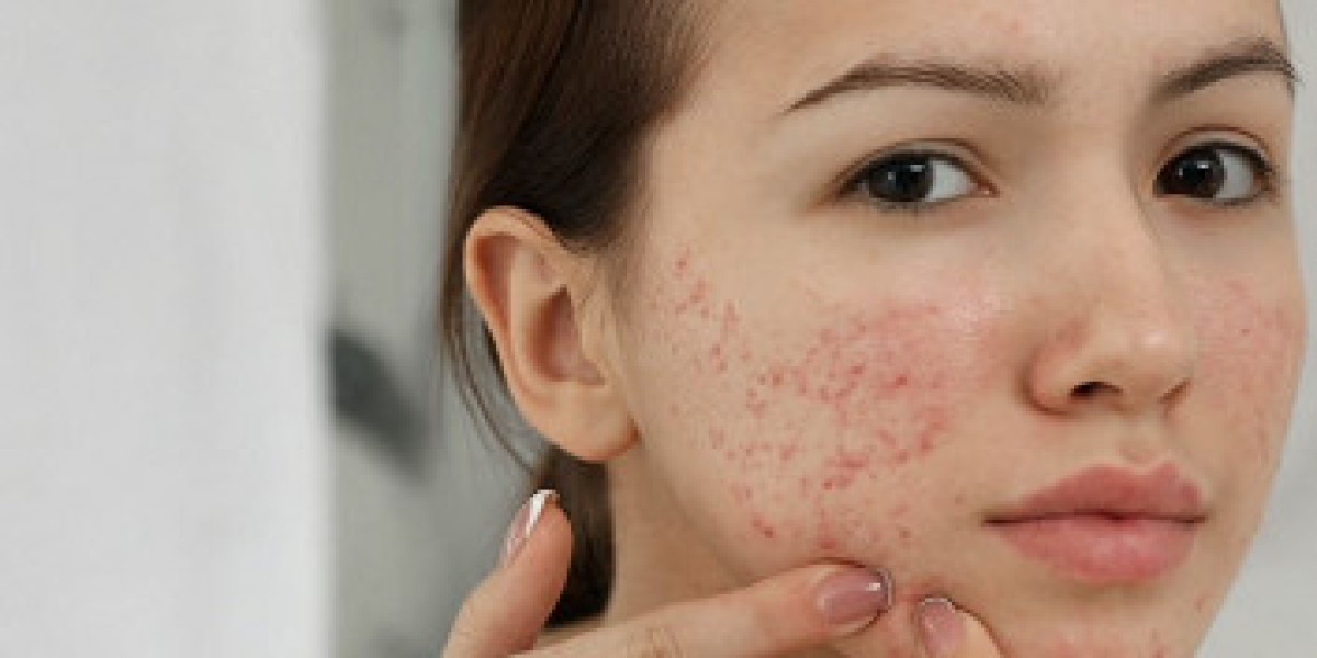 Pimple Treatment in Dubai: Prevent Breakouts with Lifestyle & Diet