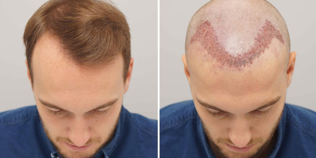 Best Hair Transplant in Sharjah for Natural Results