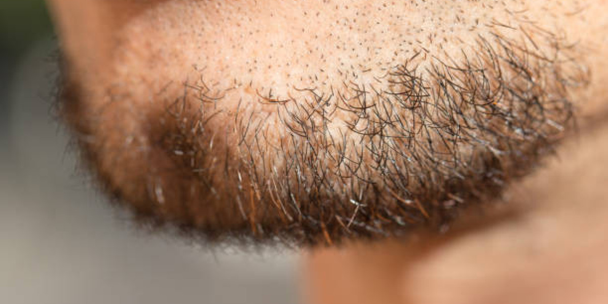 The Ultimate Guide to Beard Hair Transplant in Dubai for Men
