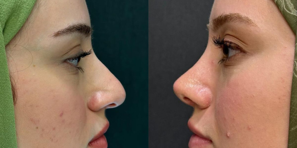 Refine Your Look with Expert Rhinoplasty in Islamabad