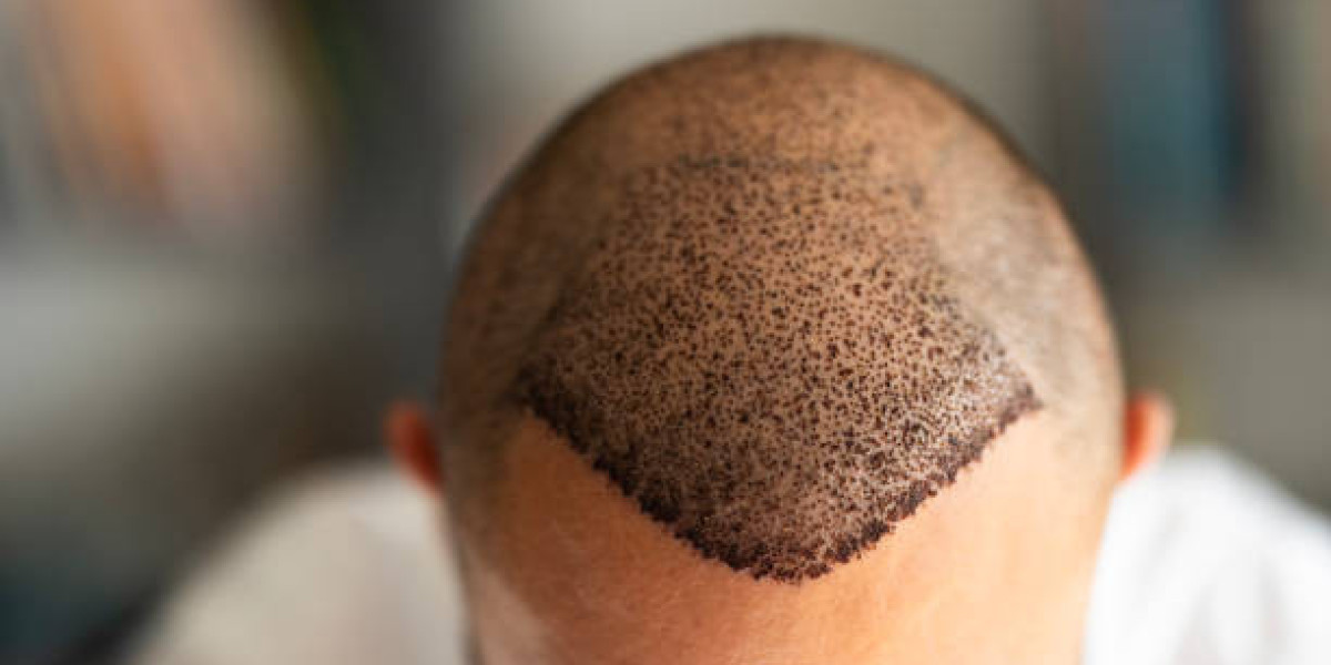 Hair Transplant in Dubai: A Complete Guide for First-Time Patients