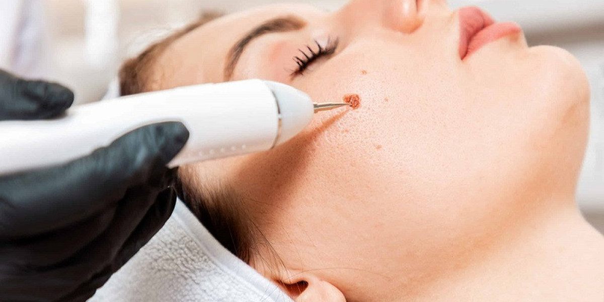 Mole Removal In Dubai: What Doctors Recommend