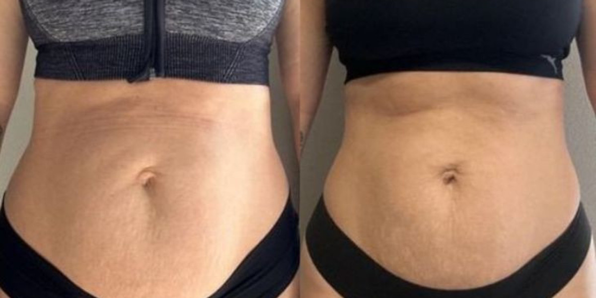 Liposuction in Islamabad – Achieve Your Ideal Body Shape