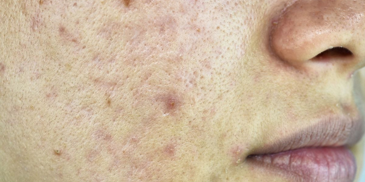 Acne Removal Dubai: Non-Invasive Techniques
