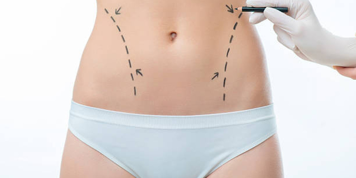 Can Liposuction in Riyadh Be Combined With Other Procedures?