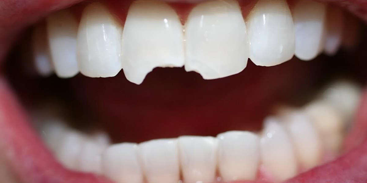 Teeth Fracture Treatment in Islamabad | Fast Smile Fix