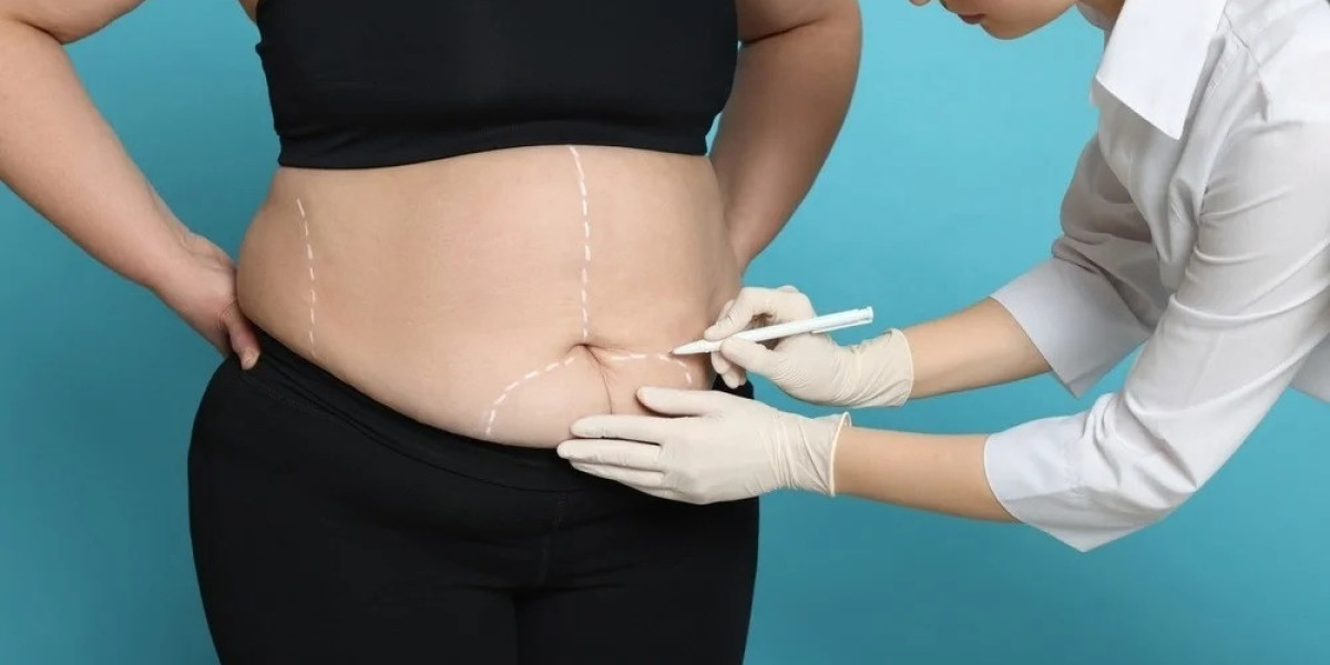 Gastric Sleeve vs. Gastric Bypass: Which Bariatric Surgery Is Better?