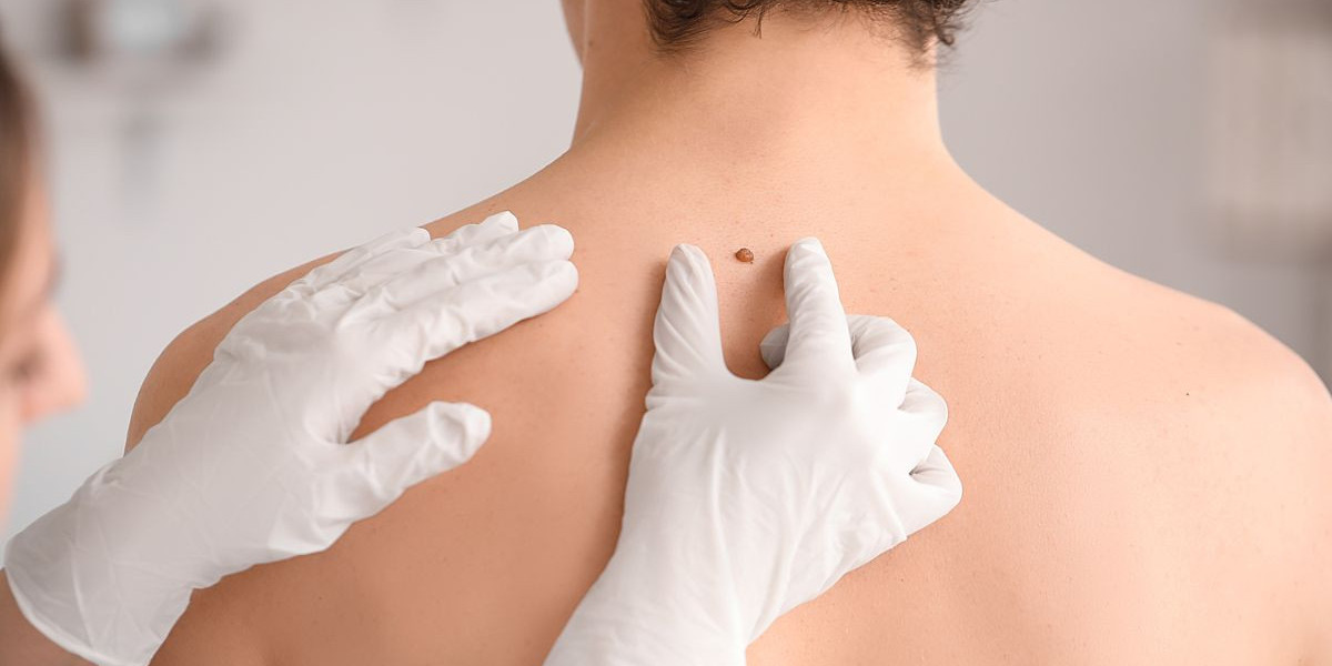 Safe Skin Tag Removal Treatment for Face and Body