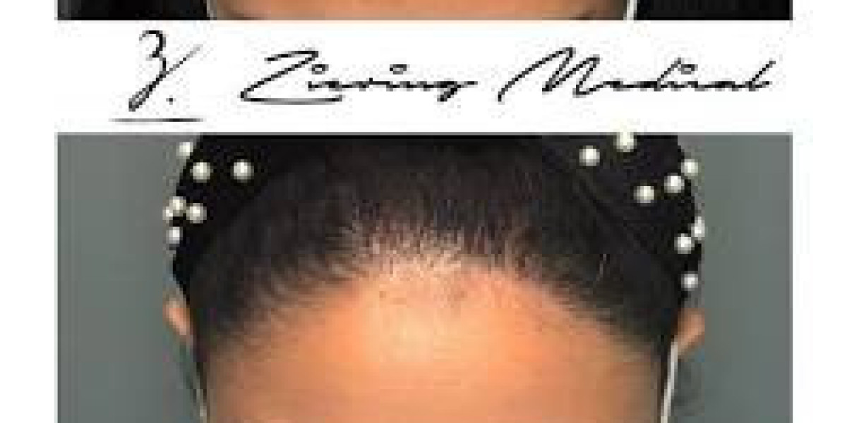 Top 5 Female Hair Transplant Techniques Revolutionizing Los Angeles Clinics