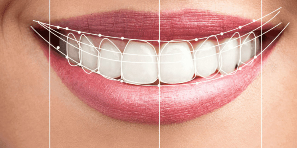 Hollywood Smile in Dubai: Achieve a Celebrity-Style Smile Today