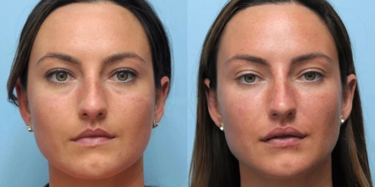 Thread Lift Treatment in Dubai Creating Youthful Facial Contours
