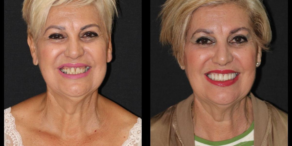Blanqueamiento Dental en Hospitalet de Llobregat Dientes Más Blancos y Brillantes