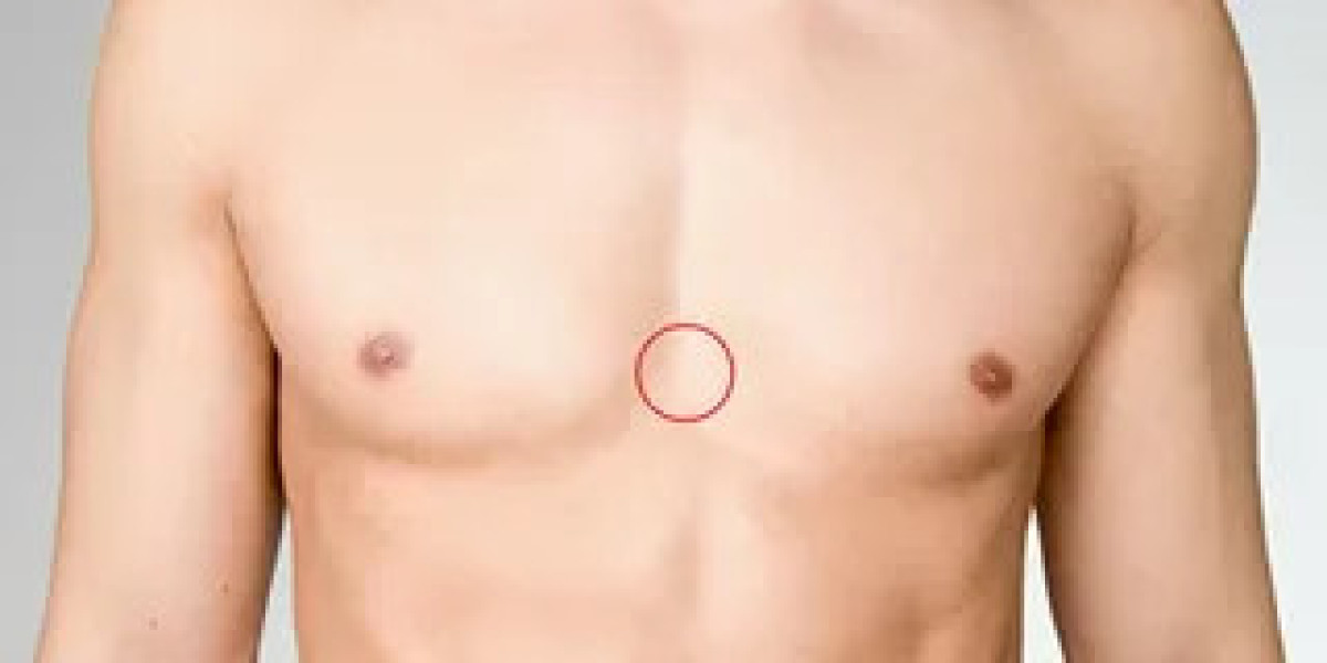 Gynaecomastia Surgery in Dubai: Restoring Your Masculine Chest
