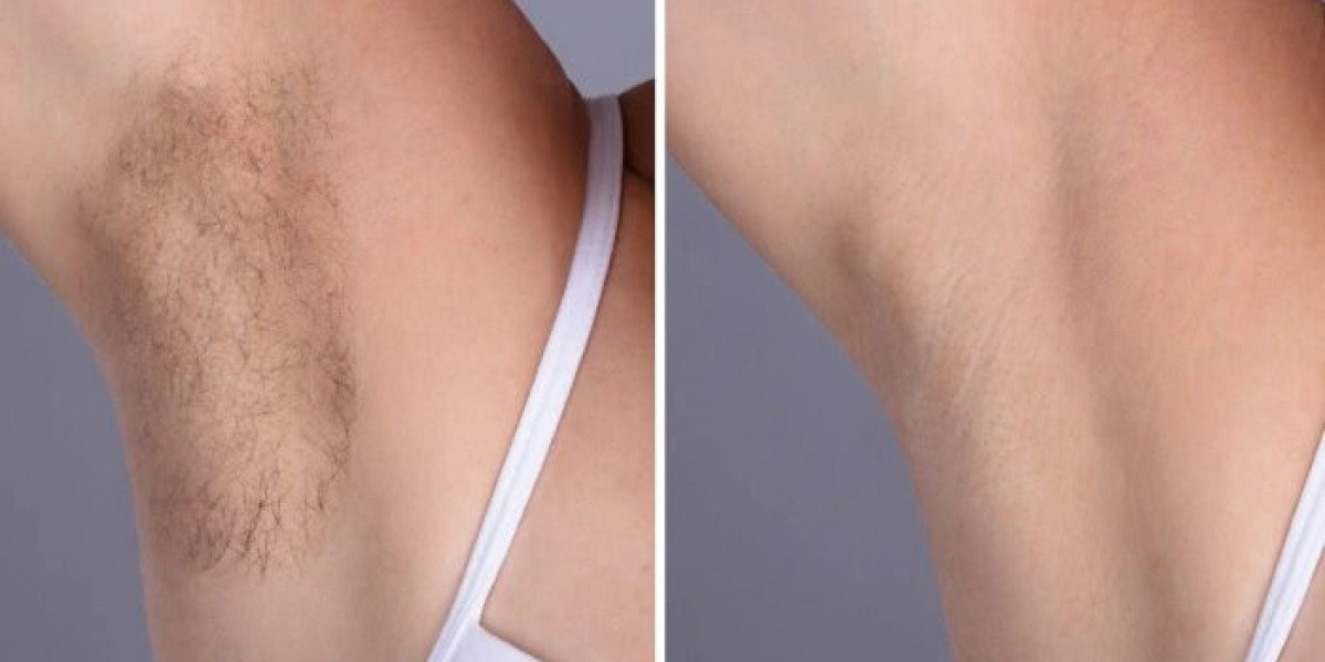 Electrolysis Laser hair removal in dubai: The Future of Hair Removal Technology