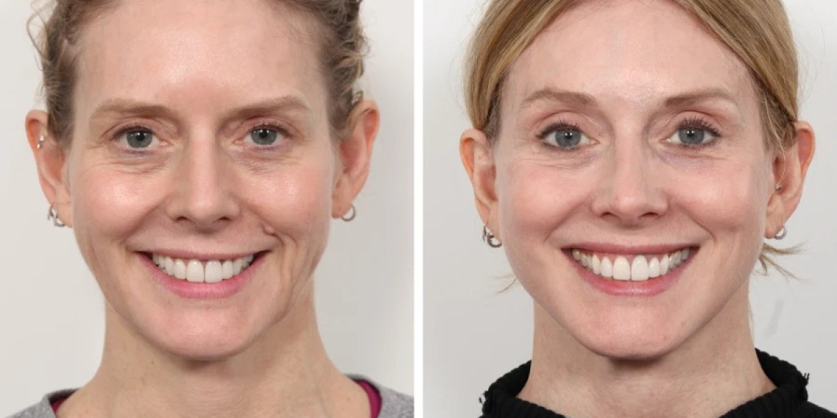 Best Plastic Surgeons in dubai for Facial Thread Lift Rejuvenation