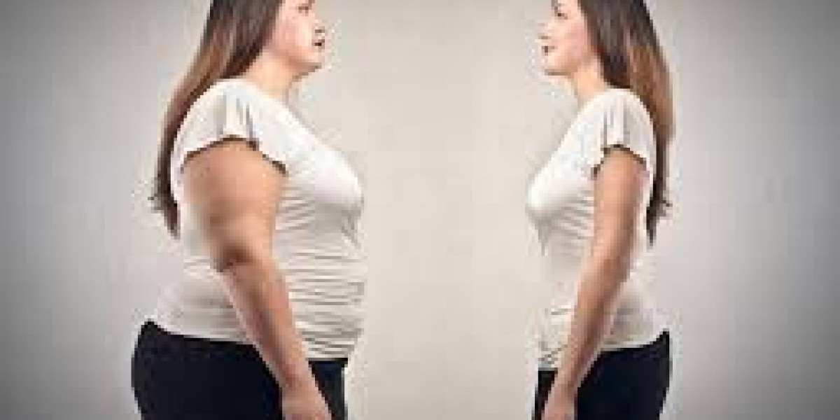 Real Expectations from Liposuction in Riyadh Journey