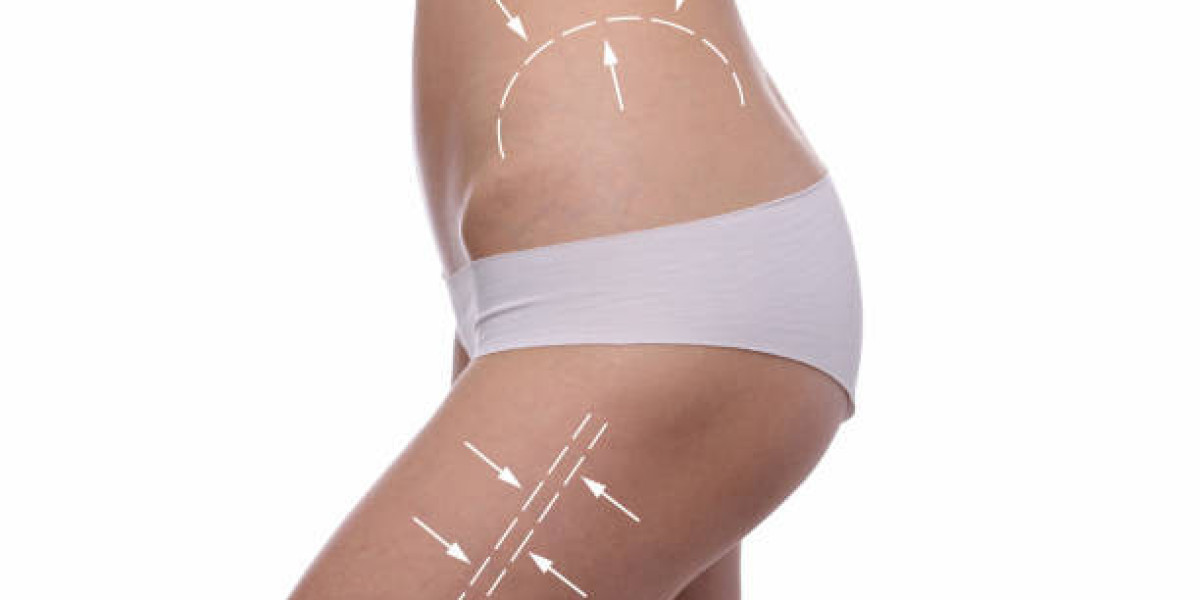 Body Sculpting Procedure for Enhancing Natural Body Symmetry