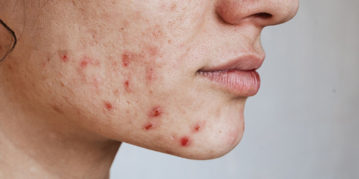 Acne Treatment in Dubai Clearer Skin Through Advanced Dermatology