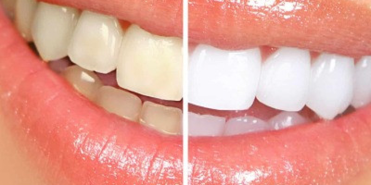 Teeth Whitening in Islamabad for Teenagers & Adults