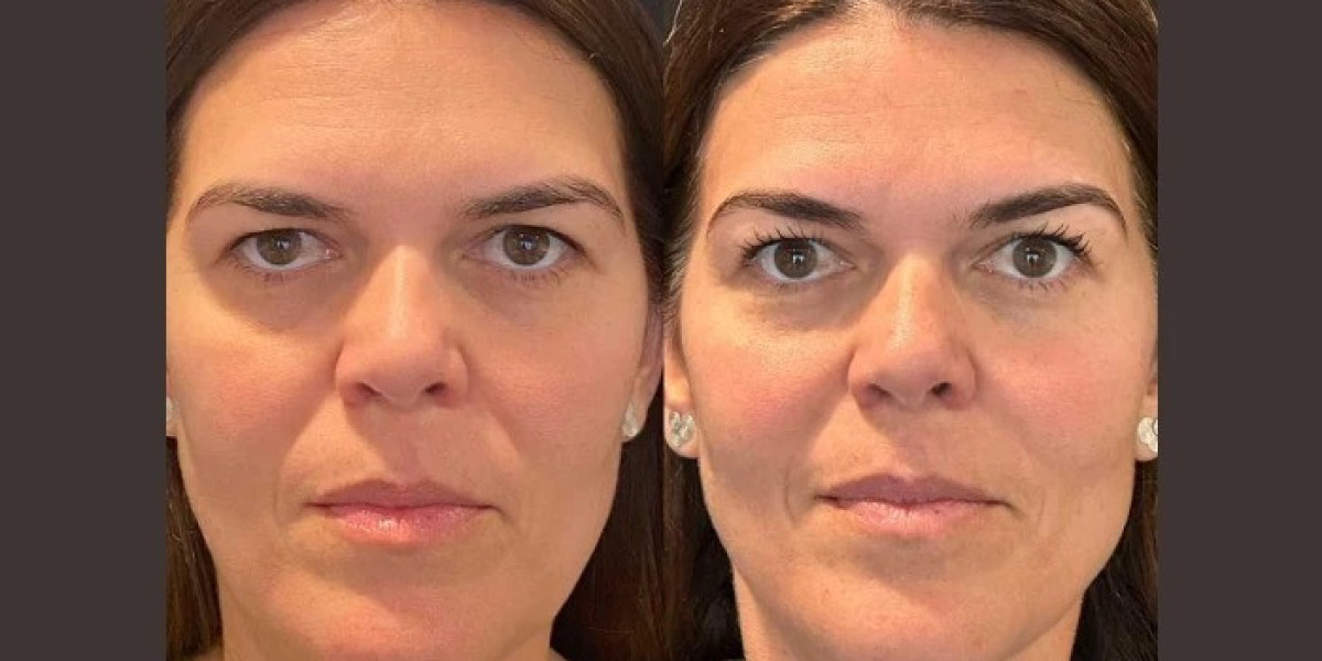 Thread Lift Procedures Trusted at Best Aesthetic Clinics in Dubai