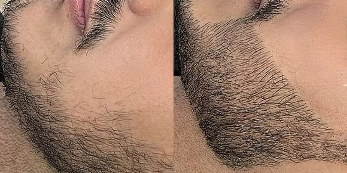 Beard hair transplant in Dubai: Maximizing long-term success and aging