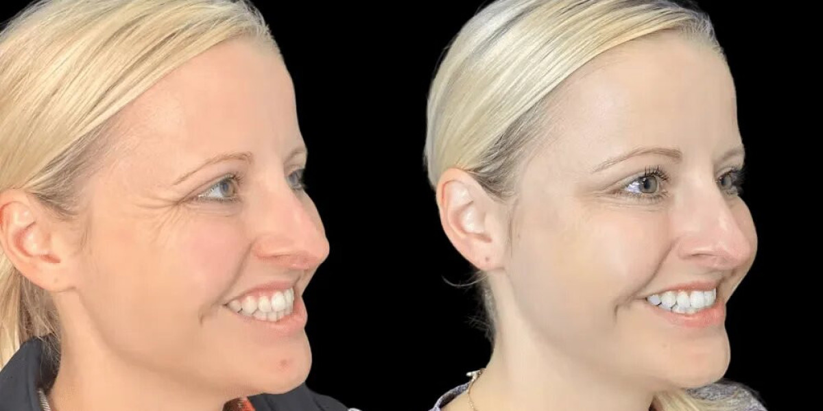 How Best Doctors in Dubai Customize Botox for Every Face Shape