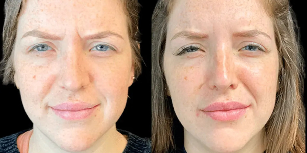 Best Aesthetic Clinic in Dubai: The Role of Skilled Injectors in Botox Success