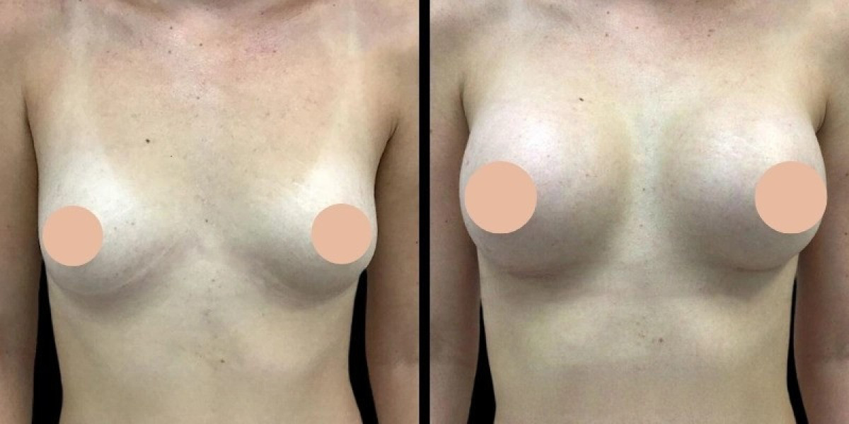 Latest Techniques in Breast Augmentation Offered by the Best Doctors in Dubai