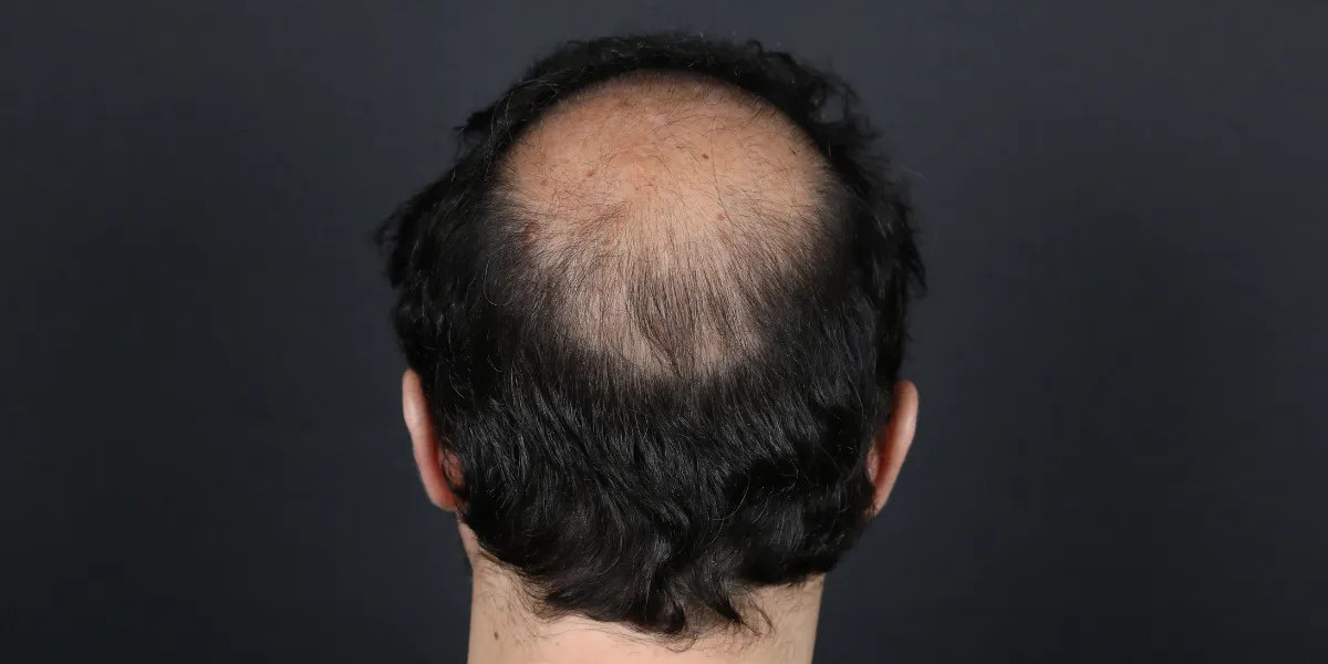 Who is the Best Candidate for a Crown Hair Transplant?