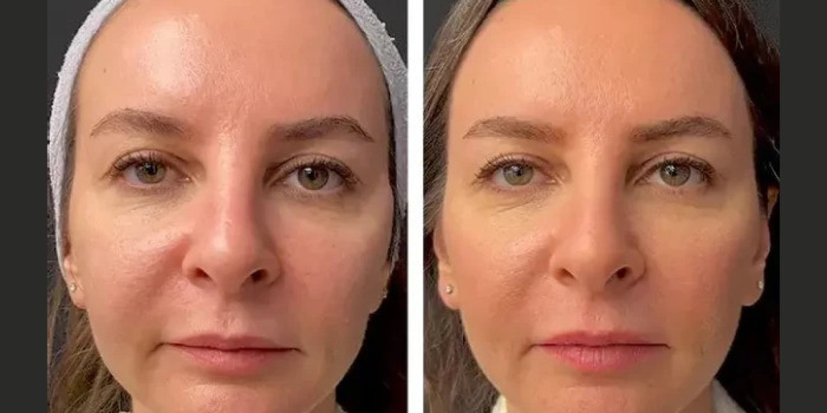 Mesotherapy in Dubai: Why Choose Professional Aesthetic Clinics