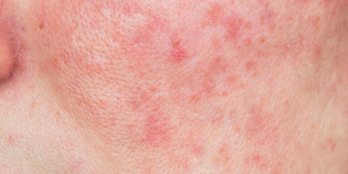 What Are The Core Principles Of Rosacea Treatment?