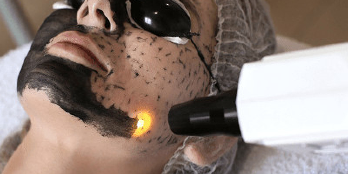 Does Spectra Carbon Peel Help with Blackheads?