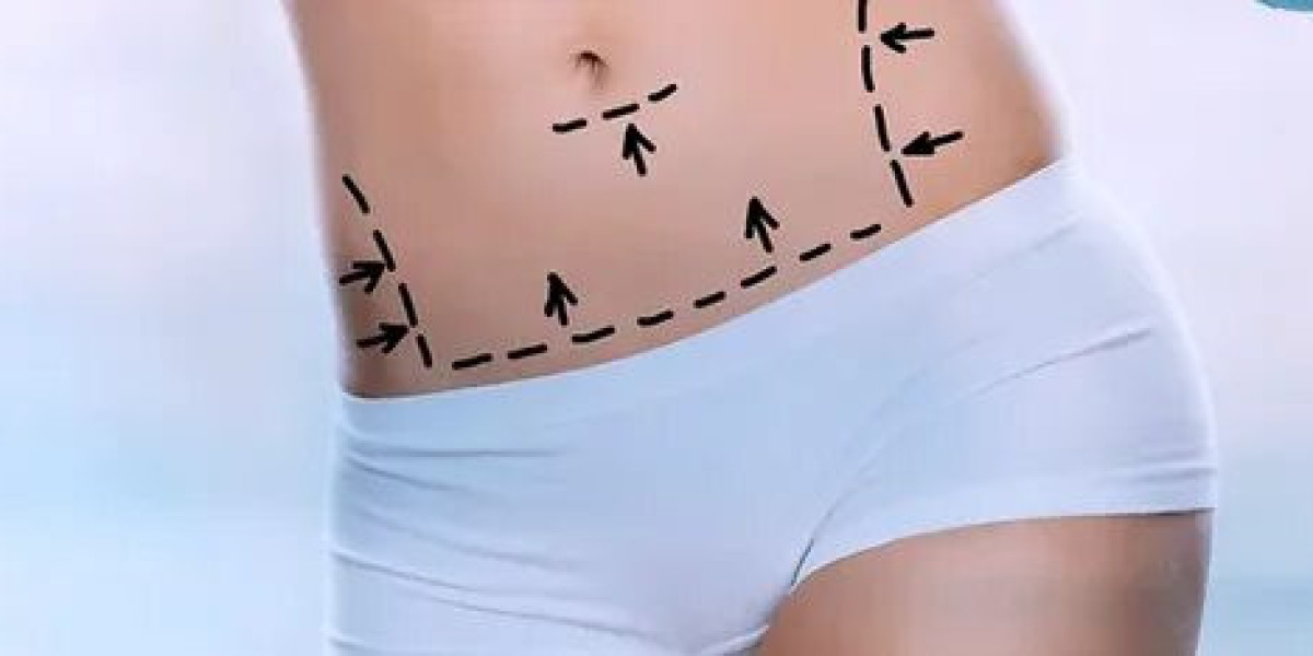 How soon can I exercise after liposuction in Dubai?