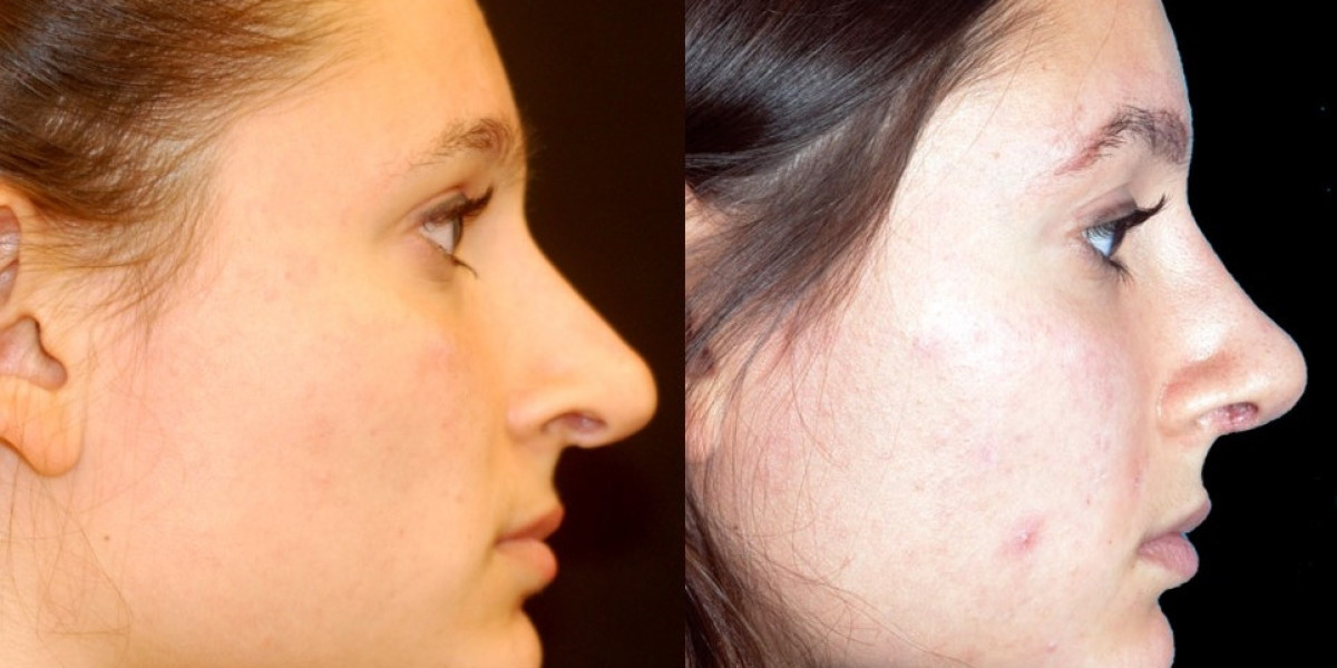 Are Non-Surgical Fillers a Long-Term Alternative to Rhinoplasty in Dubai?