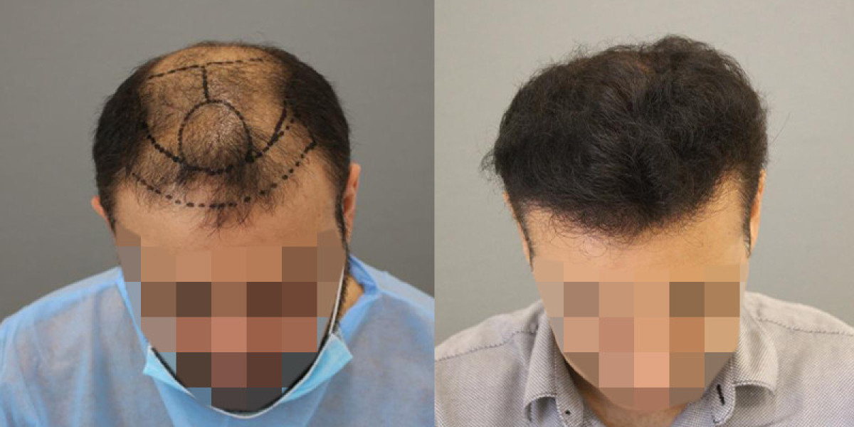 No-Shave DHI Hair Transplant in Riyadh: Discreet and Effective Results