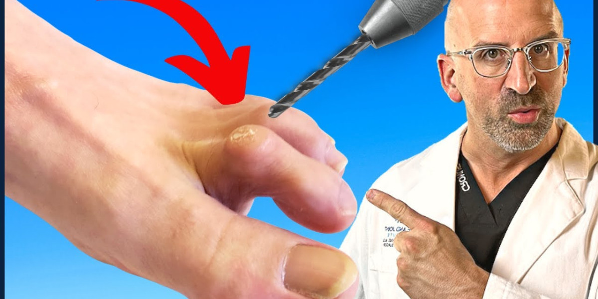 Hammertoe Pain Treatment by a Podiatrist in Edinburgh